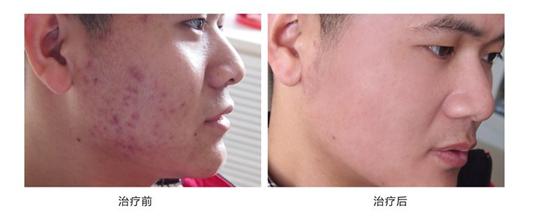 不神化的光子嫩肤，给皮肤反季节的吹弹可破！