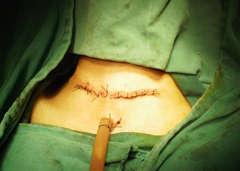 透析病人pth偏高血钙偏低,透析病人高钙血症怎么处理