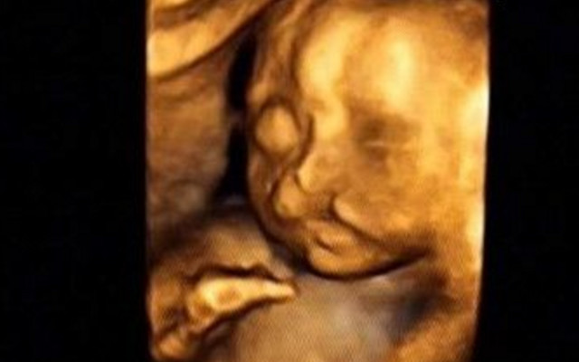 唇腭裂和兔唇四维提示什么,b超显示胎儿偏大一周会提前生吗