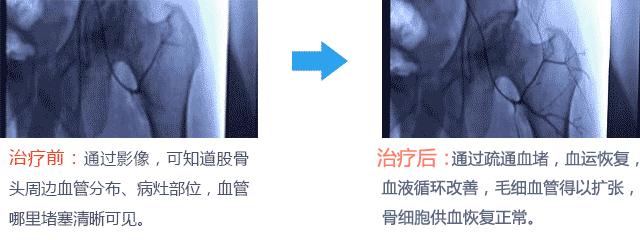 45岁股骨头坏死2期换什么样假体好,如何治疗股骨头坏死有效