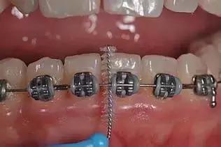 儿童口腔科正畸多大可以做,口腔戴牙套需要无菌操作么