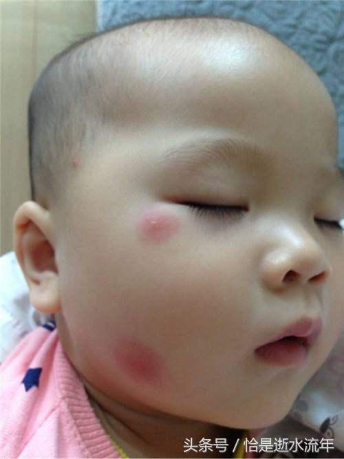 被蚊虫叮咬红肿有小红块怎么解决,宝宝蚊虫叮咬后红肿严重怎么办