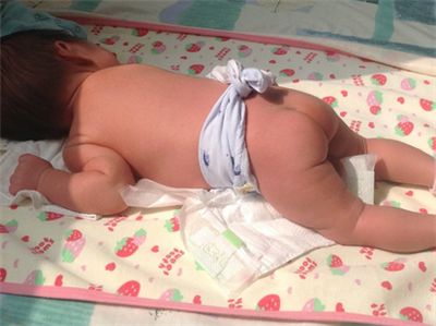 宝宝黄疸12.2需要停母乳吗,宝宝黄疸11.9医生打了预防针