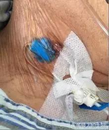 更换敷贴的操作视频,怎么换敷贴