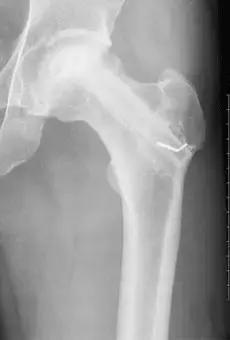 小儿股骨头坏死治疗周期,股骨头坏死置换假体寿命多久