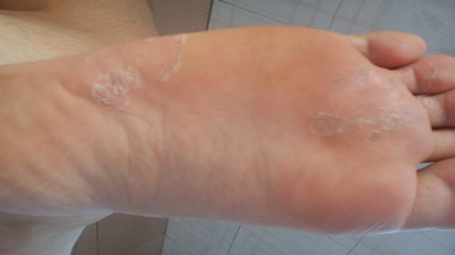 夏天脚气用什么方法最有效,脚气小偏方牙膏治脚气