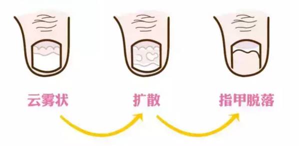小孩手指甲断了可以重新长出来么,宝宝指甲断了要不要揭开断甲