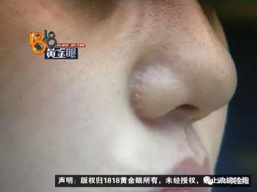 做鼻子整形手术后遗症,做鼻子手术女孩