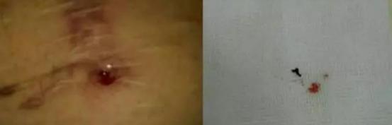 手术切口拆完线会疼吗,手术拆完线为什么还有一根线