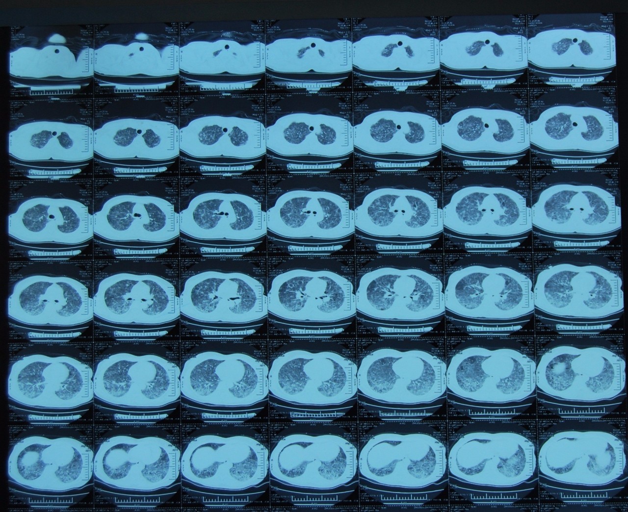 喘息、呼衰1年,问病史才发现是这个病!