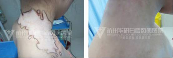 白癜风有没自愈的病例,白癜风治愈一百例