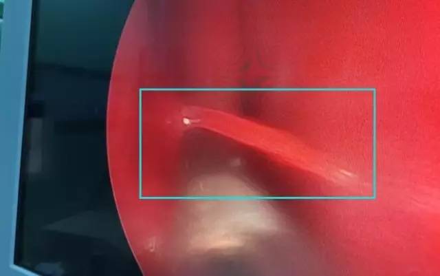 打了一个喷嚏之后鼻血狂流,打了个喷嚏鼻血狂流不止