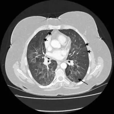 喘息、呼衰1年,问病史才发现是这个病!