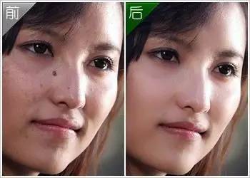 身上长痣谨慎癌变,身上的痣会癌变吗