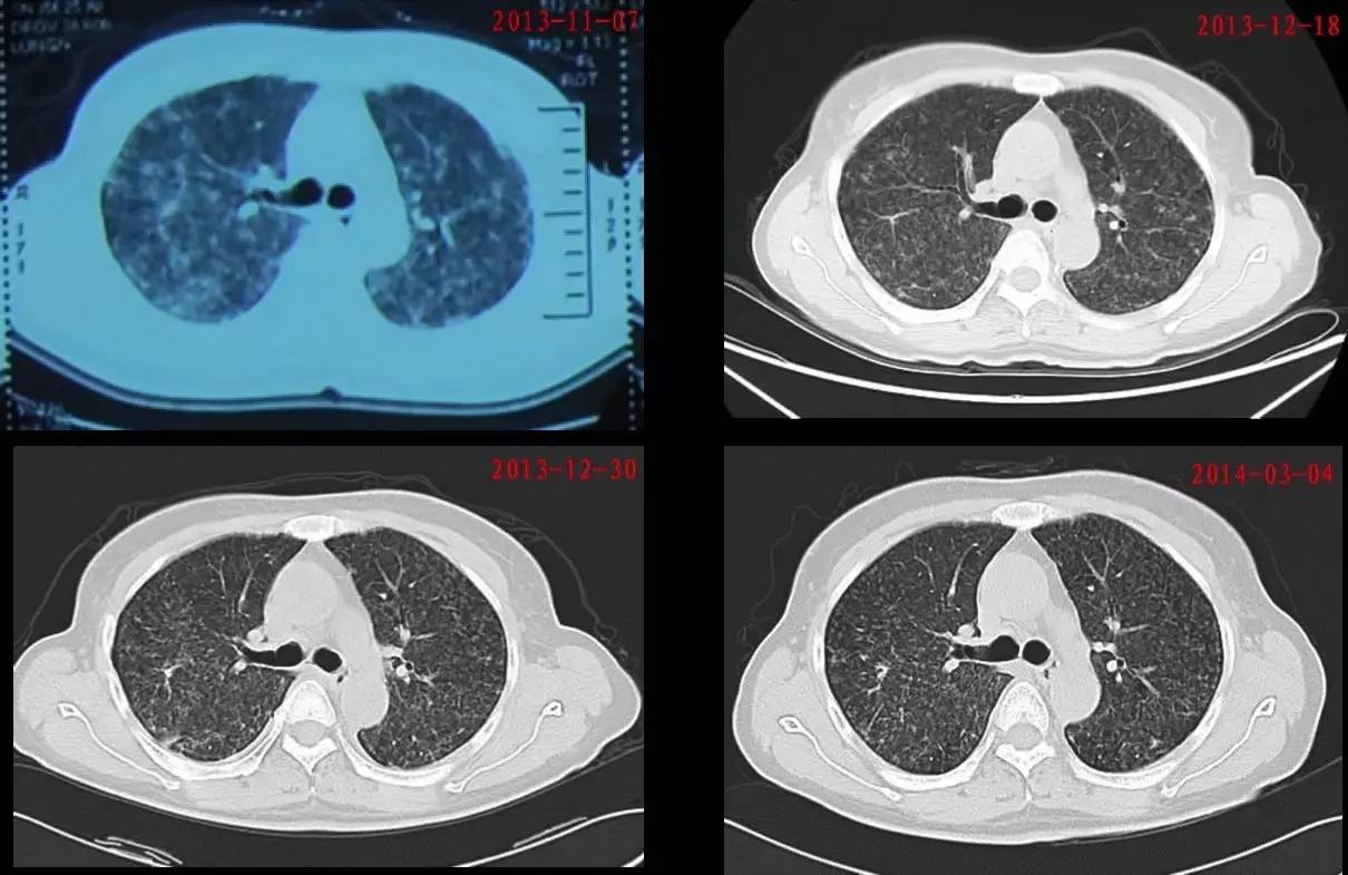 喘息、呼衰1年,问病史才发现是这个病!