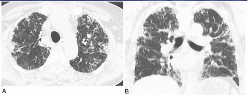 喘息、呼衰1年,问病史才发现是这个病!