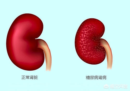 糖尿病肾病的防治,糖尿病肾病专家防治共识