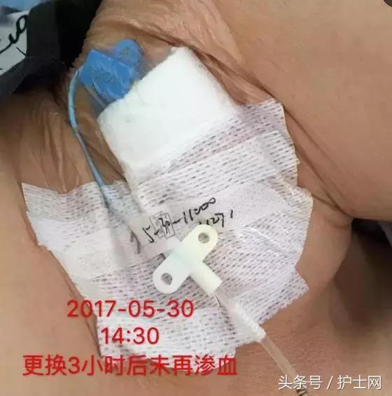 更换敷贴的操作视频,怎么换敷贴
