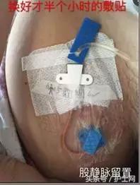 更换敷贴的操作视频,怎么换敷贴