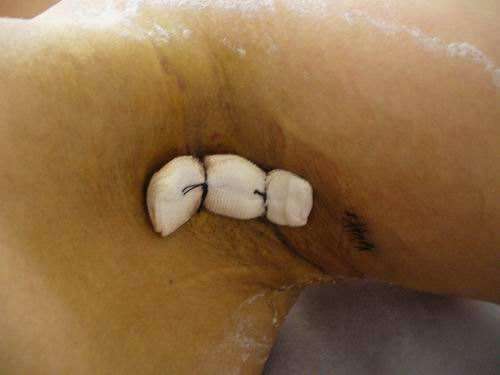 青少年狐臭怎么治疗,常见的腋臭治疗误区有哪些