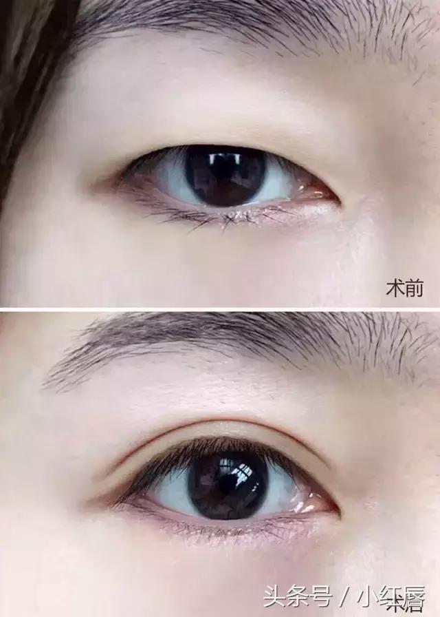 闺蜜割了双眼皮,割了双眼皮后悔了一个月