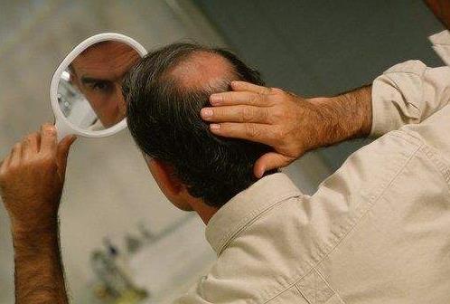 男性秃顶脱发去医院能治疗吗,男性秃顶脱发治疗最快的方法