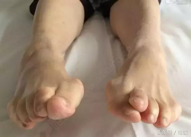 脚踝骨折手术内固定图片,踝关节骨折切开复位内固定术步骤