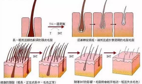男性秃顶脱发去医院能治疗吗,男性秃顶脱发治疗最快的方法