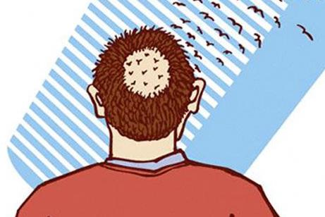 男性秃顶脱发去医院能治疗吗,男性秃顶脱发治疗最快的方法