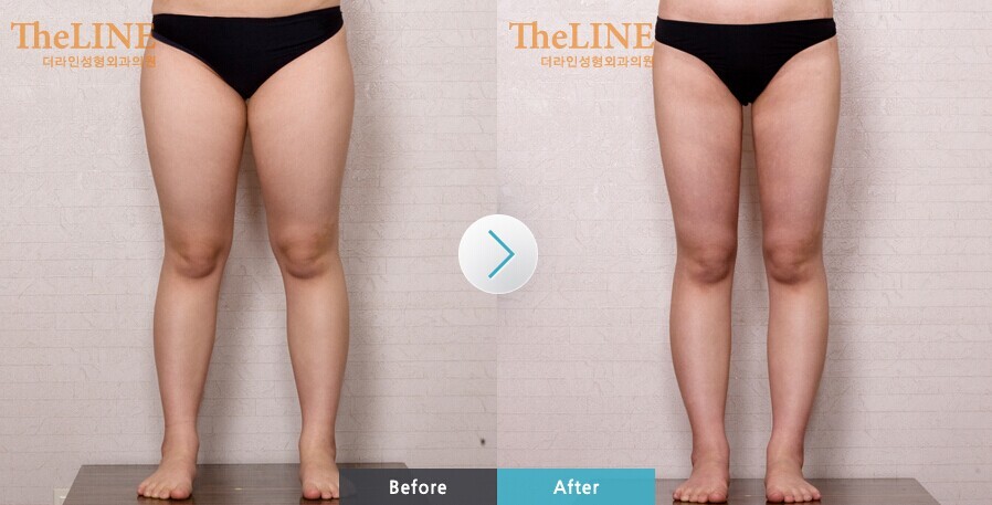 减大腿根部内侧脂肪的动作,踢毽子瘦大腿根部的脂肪