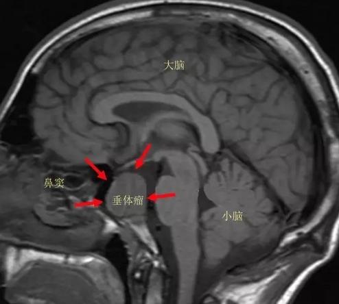脑垂体瘤变丑,垂体瘤引起肢体肥大症能恢复吗