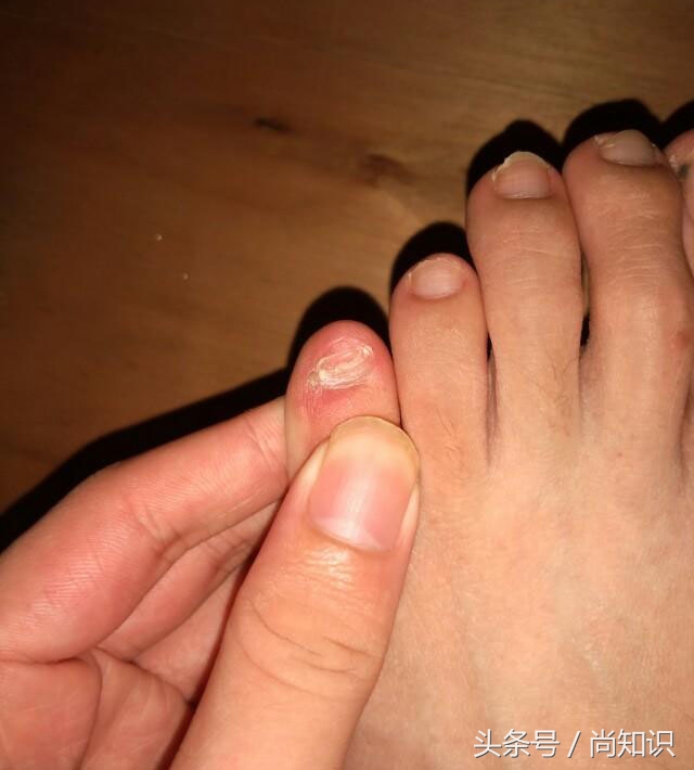 小脚趾甲为什么有两瓣的传说,为什么我们有两个小脚趾甲