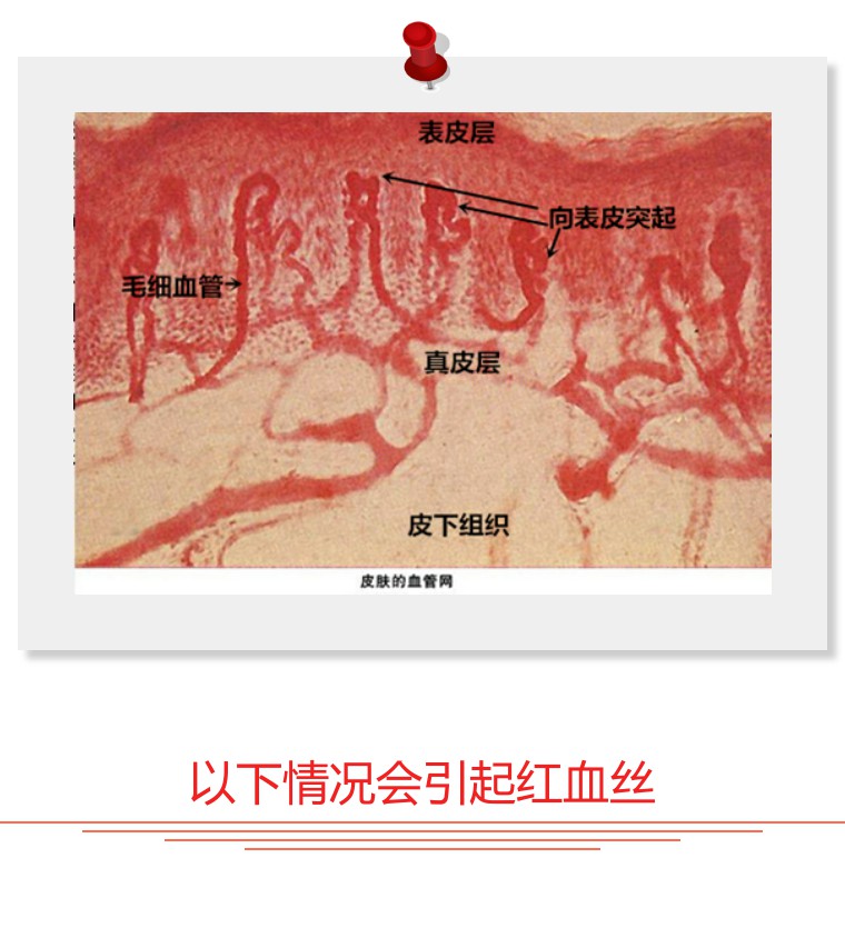 大腿上有血丝怎么祛除,血丝色斑