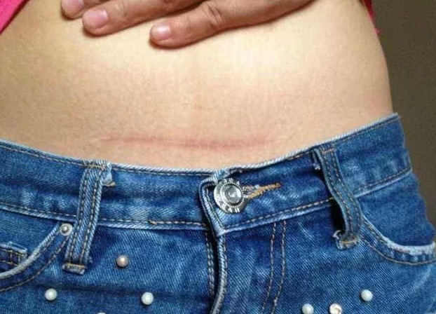 剖腹产如何关注腰护理,剖腹产二胎产后三天饮食关注