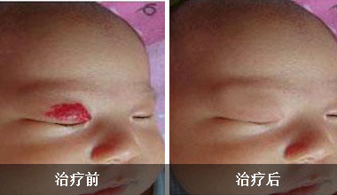 2个月婴儿头顶上血管瘤需治疗吗,2个月宝宝头上血管瘤