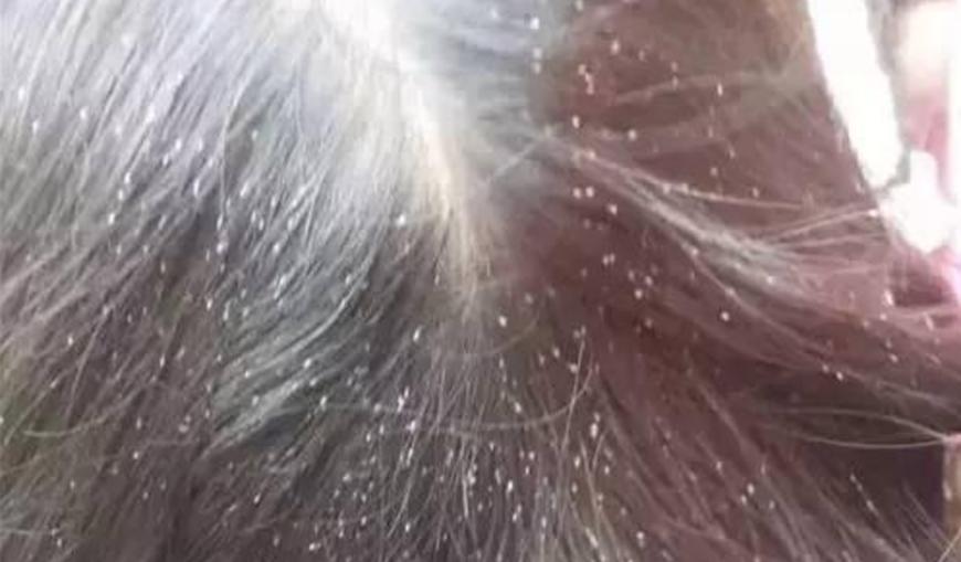 孩子头发有头皮屑原因,孩子头发痒有头皮屑怎么办