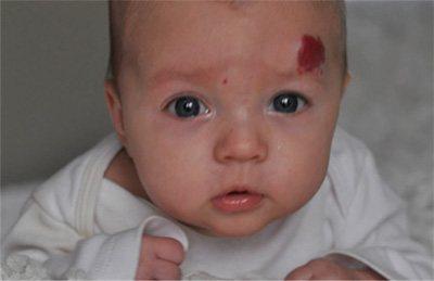 2个月婴儿头顶上血管瘤需治疗吗,2个月宝宝头上血管瘤