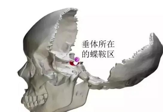 脑垂体瘤变丑,垂体瘤引起肢体肥大症能恢复吗