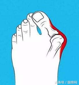 脚趾变成紫色了怎么办,脚趾形状变了是怎么回事