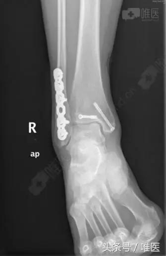 脚踝骨折手术内固定图片,踝关节骨折切开复位内固定术步骤