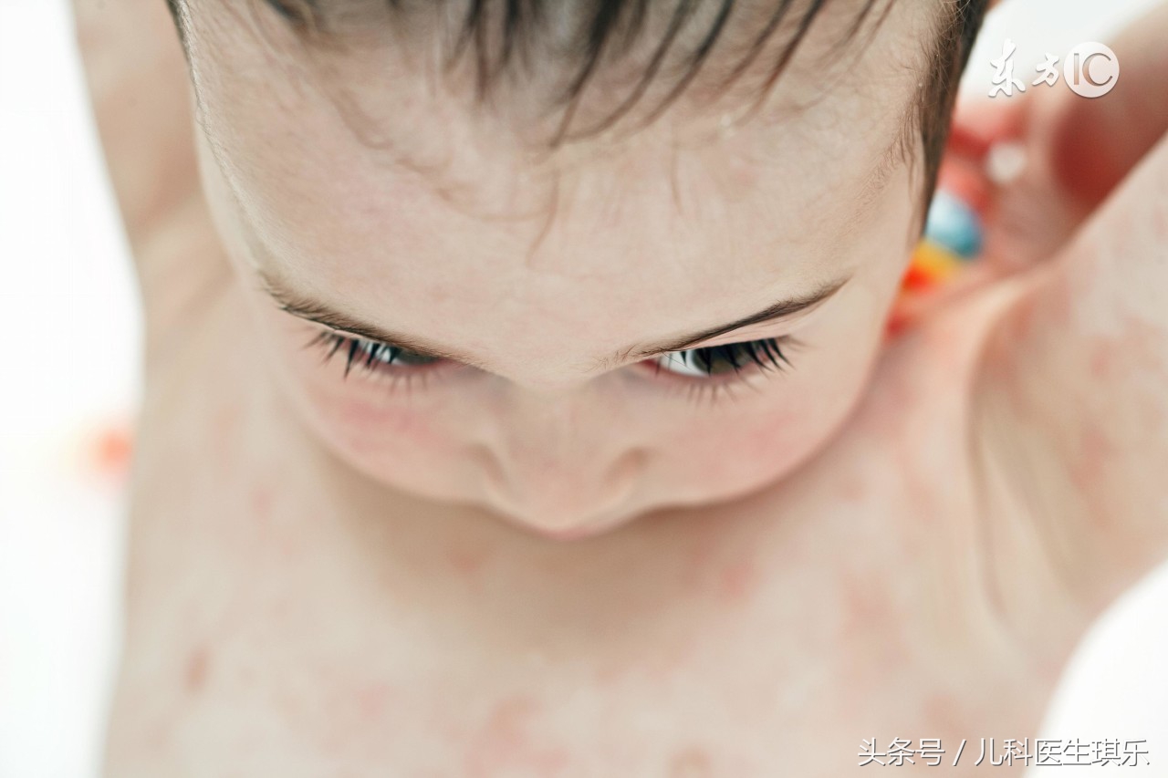 怎么区分宝宝湿疹还是痱子,怎么分清痱子和湿疹