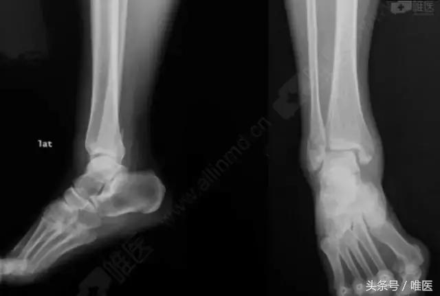 脚踝骨折手术内固定图片,踝关节骨折切开复位内固定术步骤