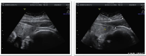 瘢痕子宫破裂症状,子宫先兆破裂症状