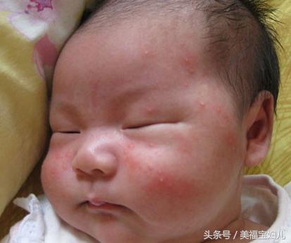 宝宝得了湿疹了怎么办？妈妈们不要慌，这样处理