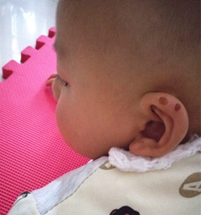 婴儿被蚊子叮咬起水泡需要处理吗,婴儿被蚊子叮咬后红肿硬起小水泡