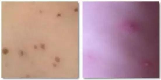 痱子不谨慎当湿疹治疗会怎么样,痱子小红点