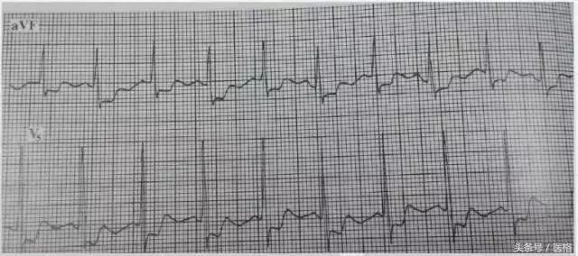 电交替,电交替现象临床意义