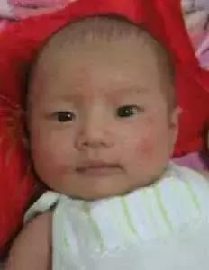 小儿大腿两侧湿疹 (小儿皮肤干性湿疹)