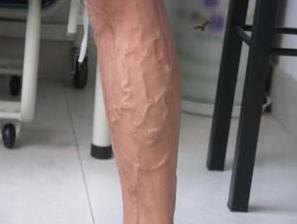 静脉曲张到底是什么？血管是不是很容易爆裂？容易溃疡？其实平时护理很重要，3个护理方法学起来，还你健康