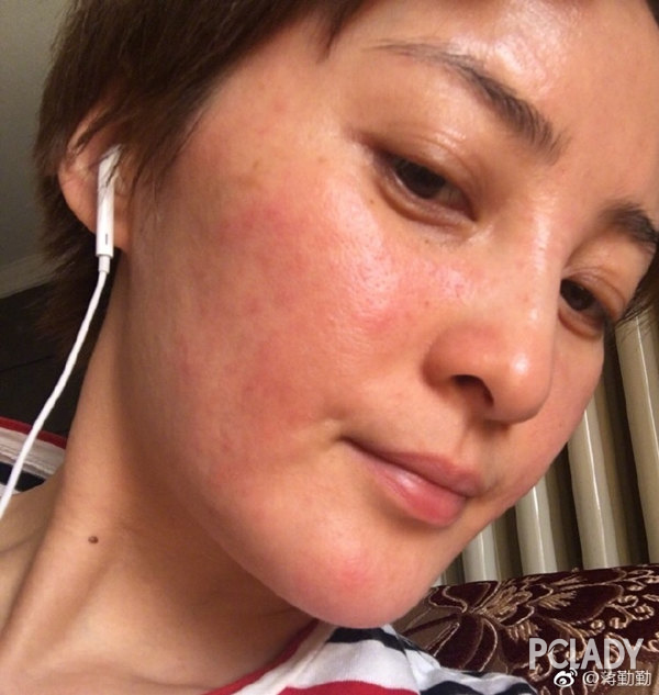 紫外线过敏舒淇,舒淇敏感肌怎么自救